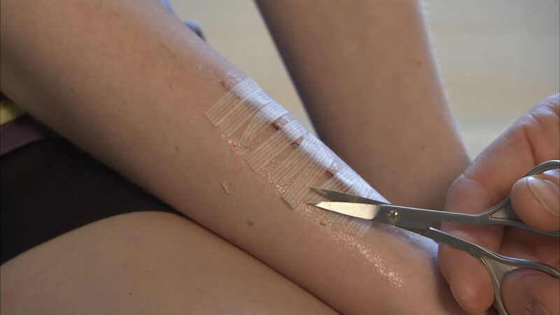 Do Wounds Heal Faster Covered or Uncovered - find out more