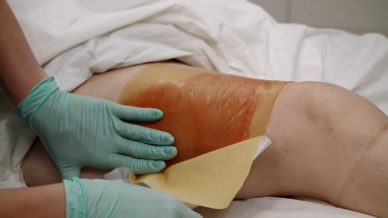 Healing benefits - Hydrogel for Wound Care