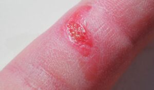 8 Signs You Have an Infected Wound: Warning Signals