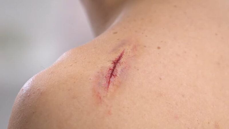 The Best and Worst Ideas for Open Wounds - The Do's and Don'ts